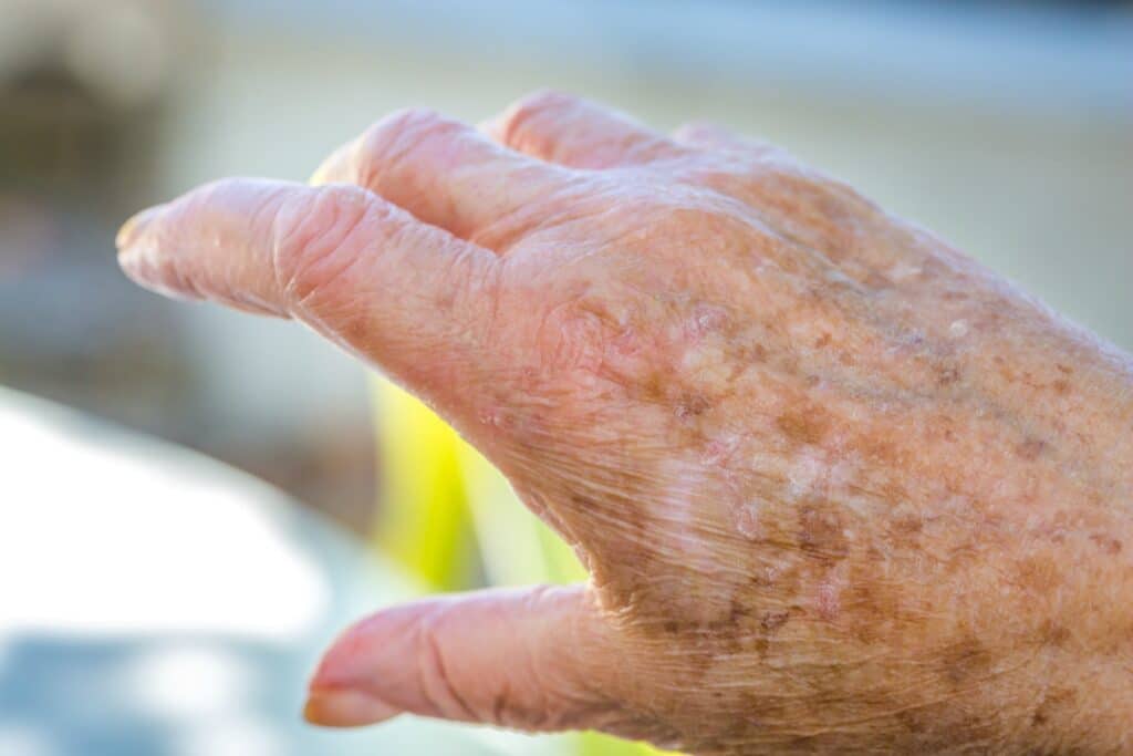 Caregiver in Oakwood GA: Dry Skin